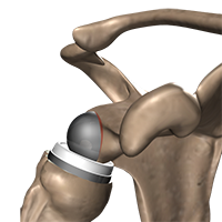 Shoulder Arthroscopy