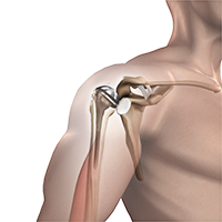 Total Shoulder Arthroplasty